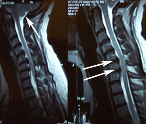 Lara's Neck MRI